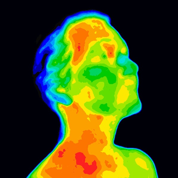Thermographic image of a human face and neck showing different temperatures in a range of colors from blue cold to red hot. Red in the neck might indicate raised CR-P levels, this could be a sign of inflammation, and Carotid Artery inflammation which could be linked to a stroke.